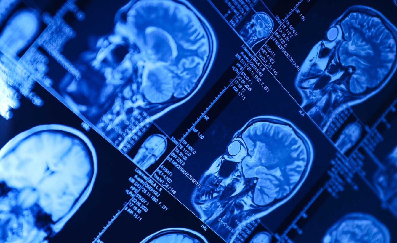 Traumatic-Brain-Injury-TBI