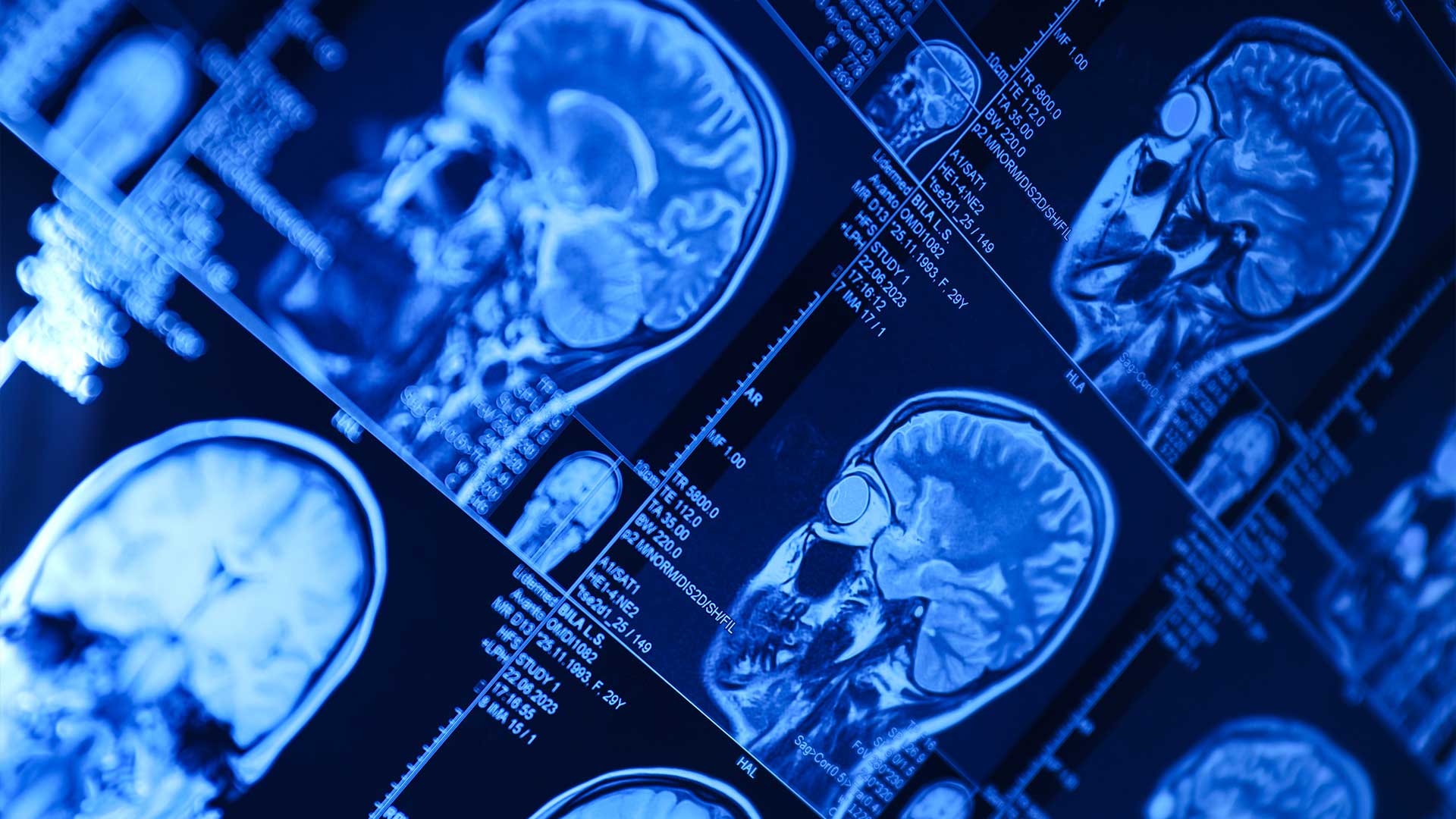 Traumatic Brain Injury