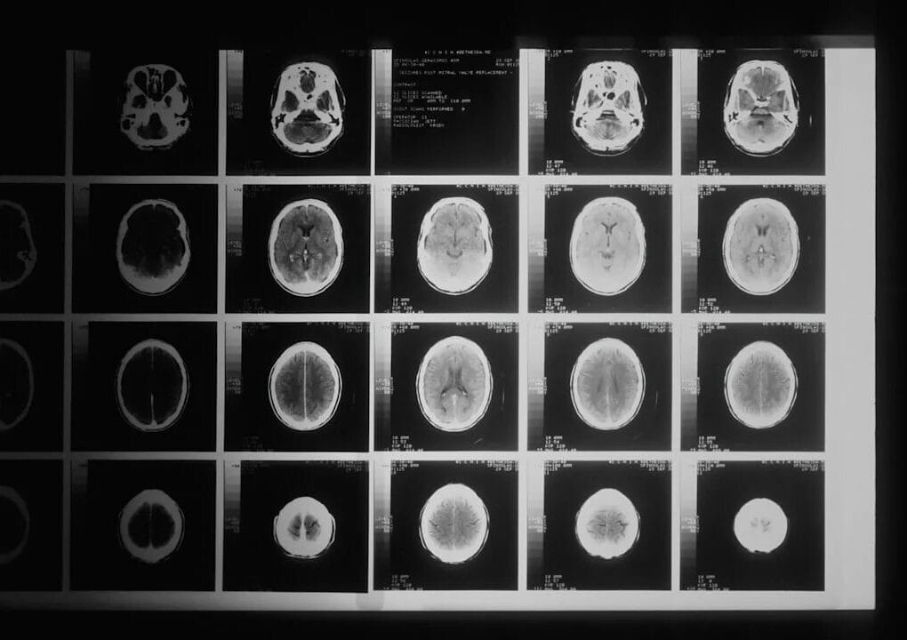 traumatic brain injury services