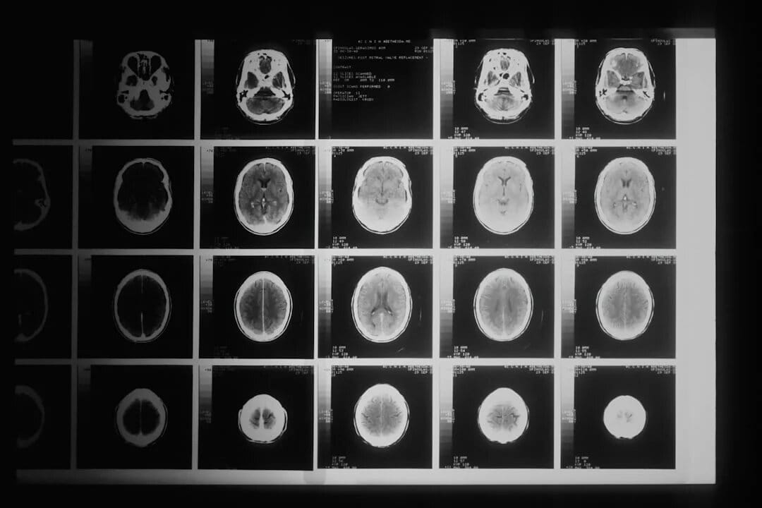 traumatic brain injury services
